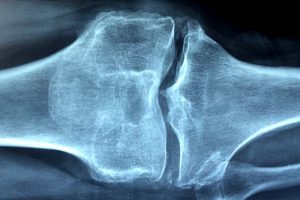 Pflanzenkraft lindert Schmerzen bei Rheumatoider Arthritis